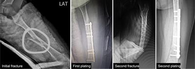 COL1A1 novel splice variant in osteogenesis imperfecta and splicing variants review: A case report